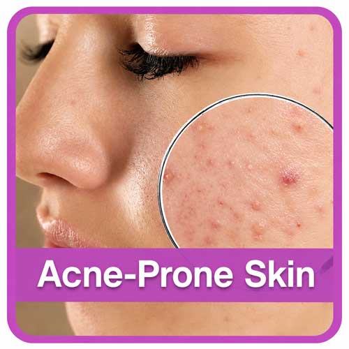 skin types