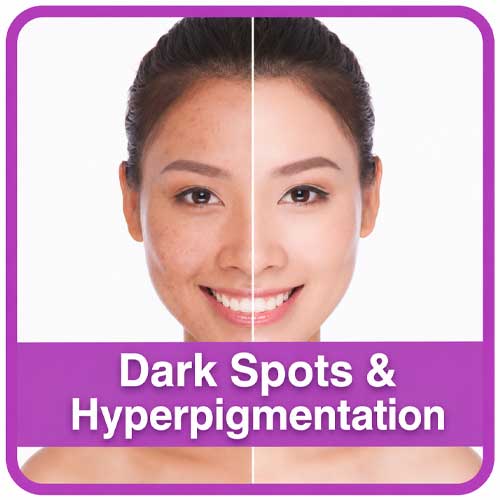 skin types