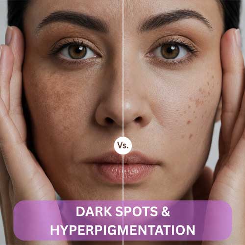 skin types